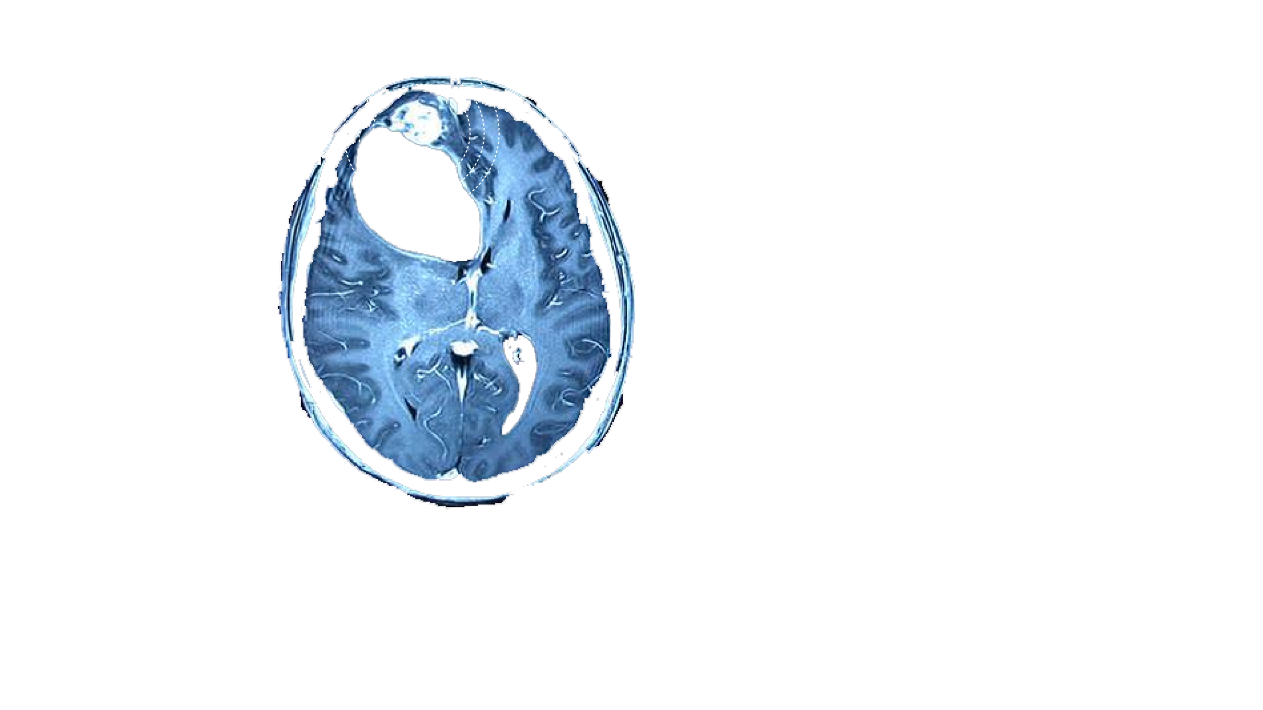 img-glioma